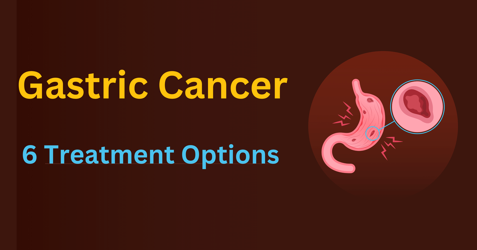 gastric cancer treatment options