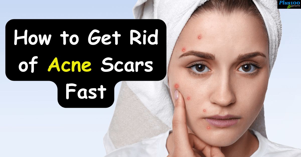 How to Get Rid of Acne Scars Fast