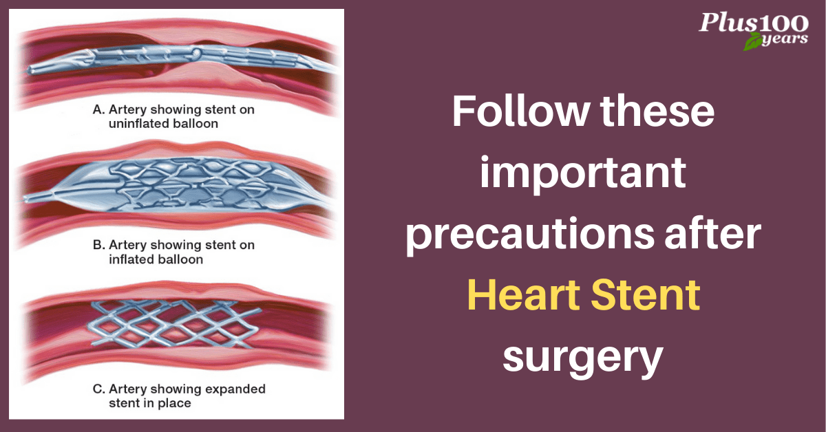 Heart Stent surgery